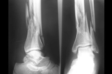 icd 10 code for distal fibula fracture left